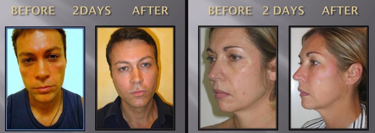 Achieve a Youthful look Most-used-botox-beverly-hill